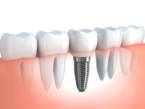 Dental Implants in Walnut Creek