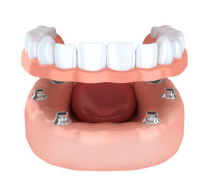 Implant supported denture in Walnut Creek CA